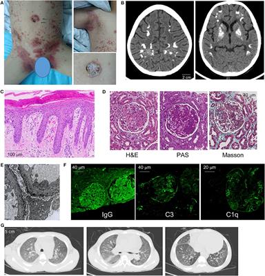 Interstitial Lung Disease and Psoriasis in a Child With Aicardi-Goutières Syndrome